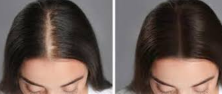 Restore Your Hair with ELORAA CLINIQ's Hair Res... main image