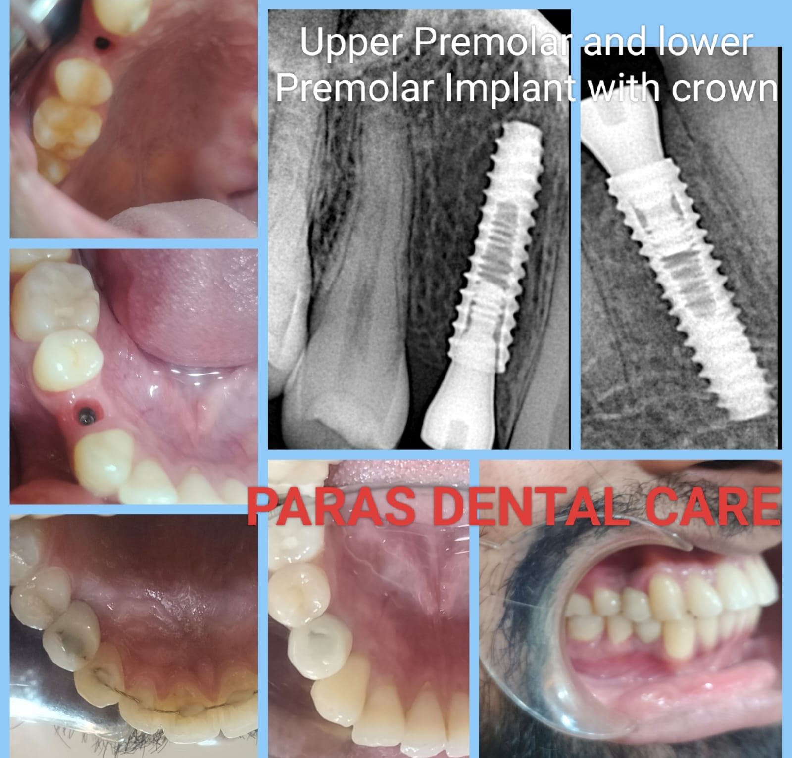 Dental Implants at Paras Dental Clinic, Vivek V... main image