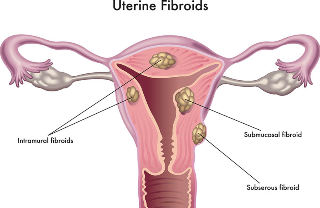 Best Fibroid Uterus Treatment Near Me in Nagpur... main image