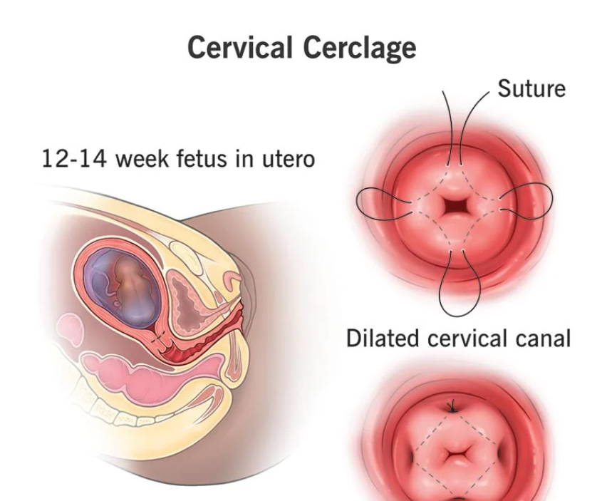 Best Cervical Cerclage Procedure Near Me in Nag... main image