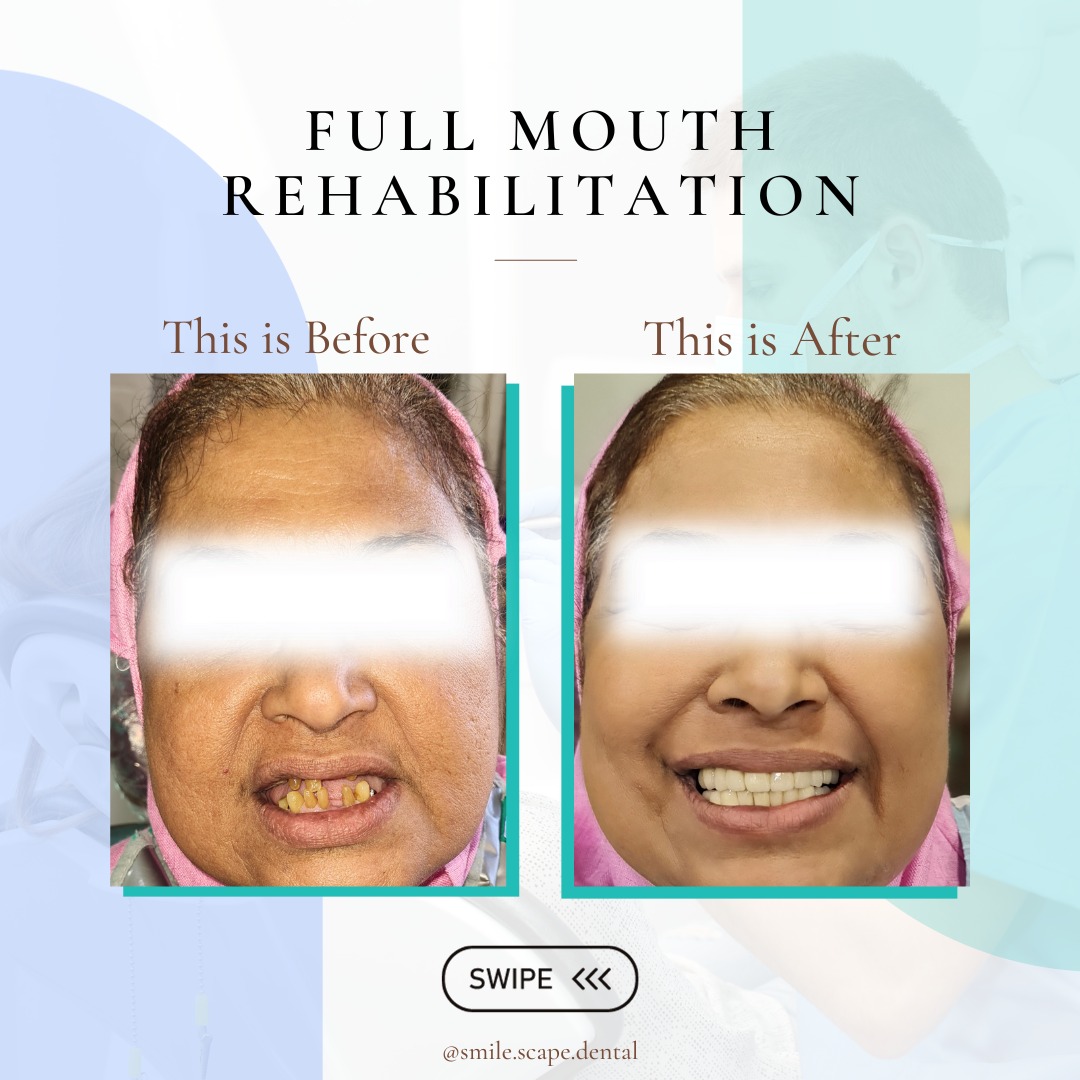 Missing teeth has a negative impact on digestio... main image