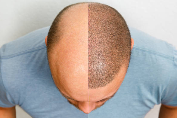 Best Hair Transplant Center in Jaipur Regain Yo... main image
