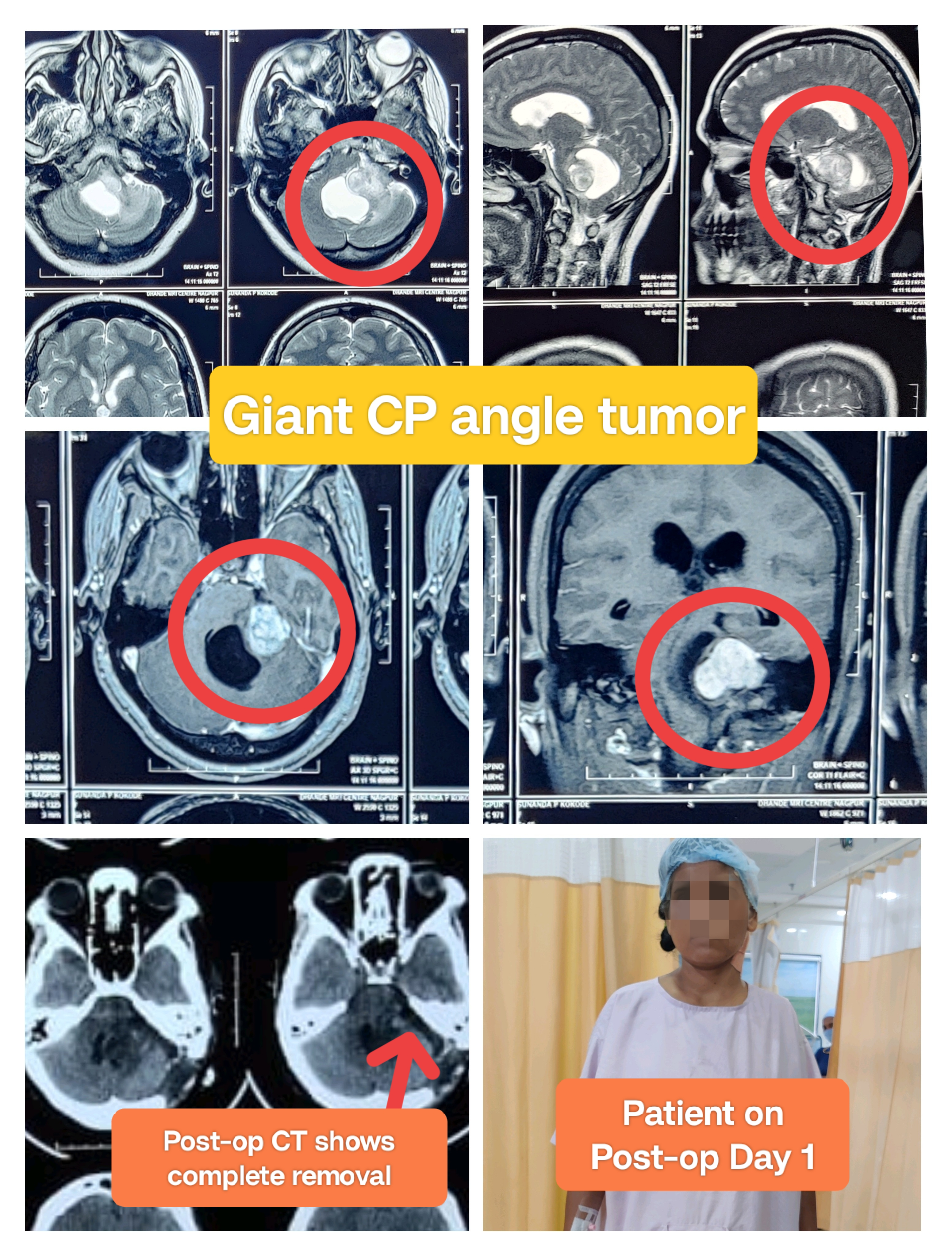 45 year female having left side complicated Giant ... main image
