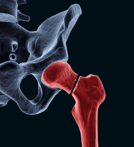 Neck of Femur Fracture Solutions at KC Hospital Be... main image