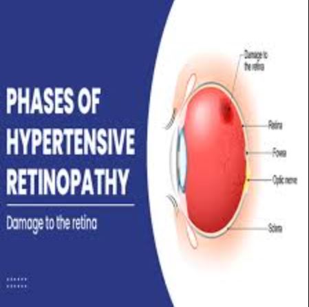 Effective Management of Hypertensive Retinopath... main image