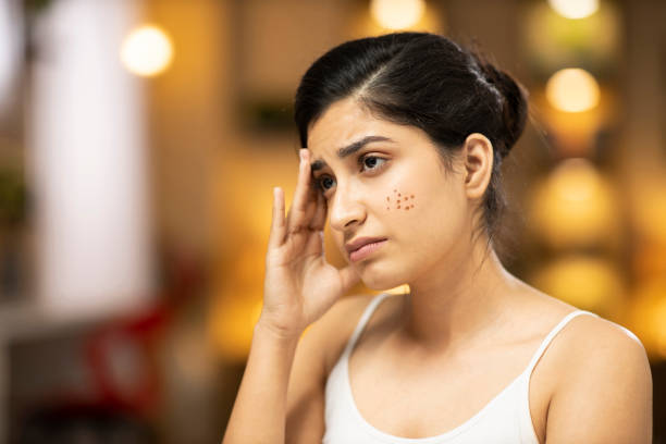 Acne and Acne Scars Treatment in Chennai Clear You... main image