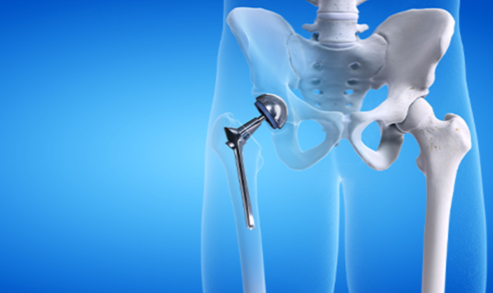 Hip Replacement at KC Hospital Best Hip Replace... main image
