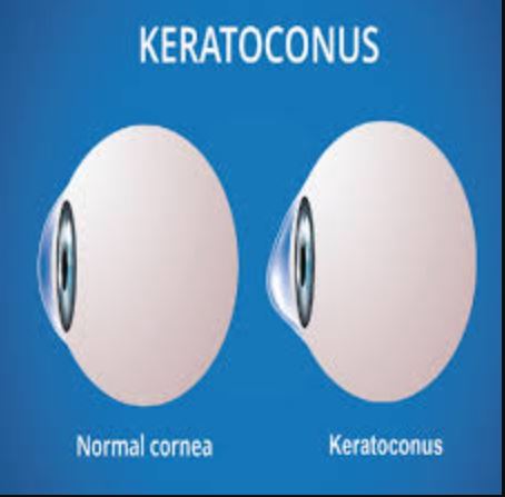 Comprehensive Care for Keratoconus at Green Cit... main image