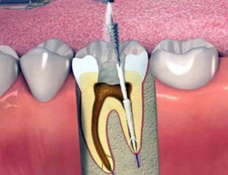 Root Canal Treatment at Dr. Rai's Dental Avenue in... main image