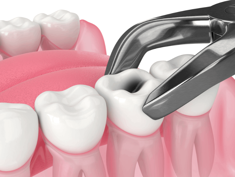 Tooth Extraction Procedure at Dr. Rai's Dental Ave... main image