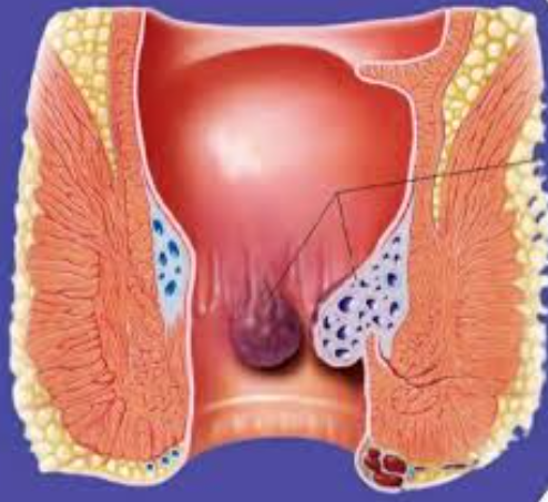 Piles Surgeon: Relief with Dr. Rajiv Manek Pile... main image
