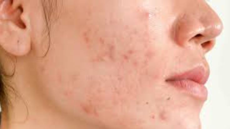 Acne and Acne Scars Treatment near R A Puram Strug... main image