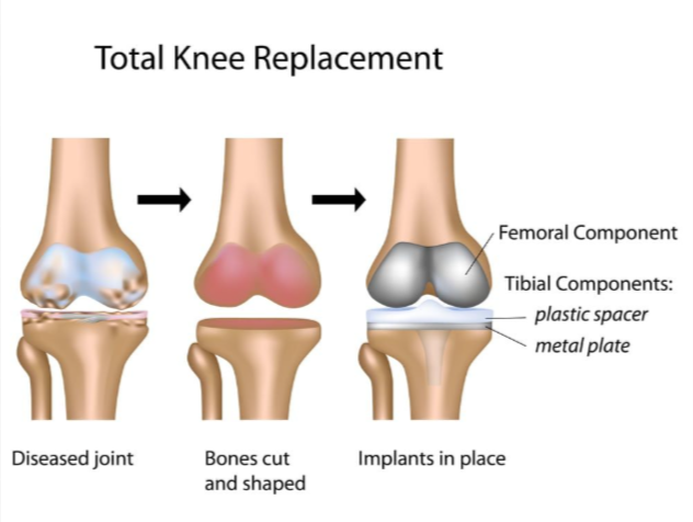 Knee Replacement at KC Hospital Best Knee Repla... main image