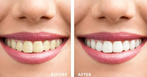 Teeth Whitening Process at Dr. Rai's Dental Avenue... main image