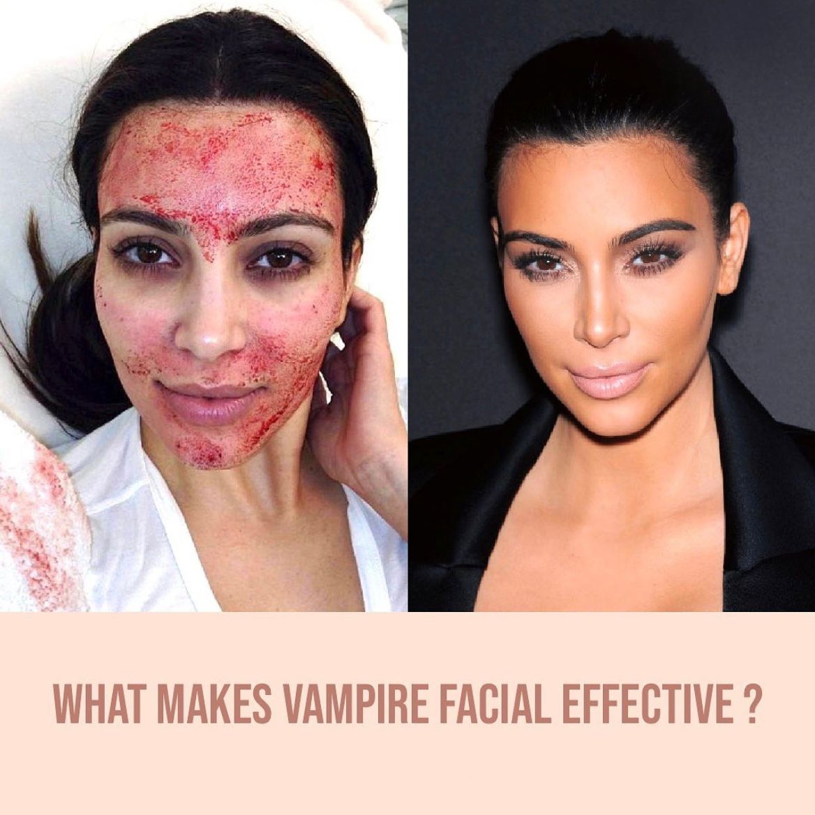 Vampire Facial: The Ultimate Skin Rejuvenation Tre... main image