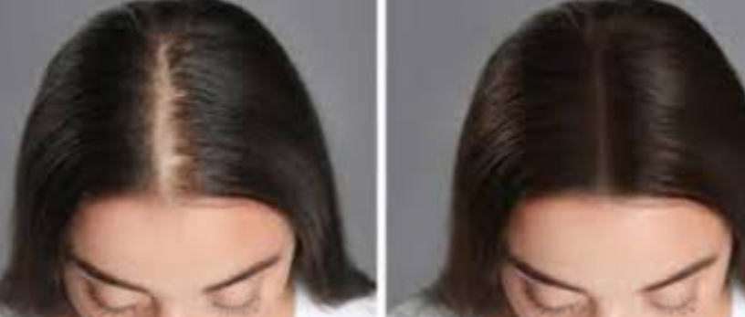Specialized Hair Implant for Women at ELORAA CL... main image