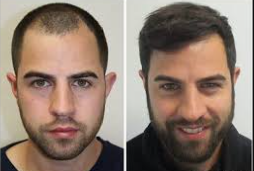 Natural-Looking Hair Plugs at ELORAA CLINIQ Hair P... main image