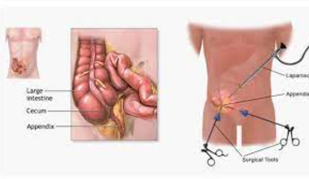 Dr. Bineet’s Expertise in Hernia and Appendix S... main image
