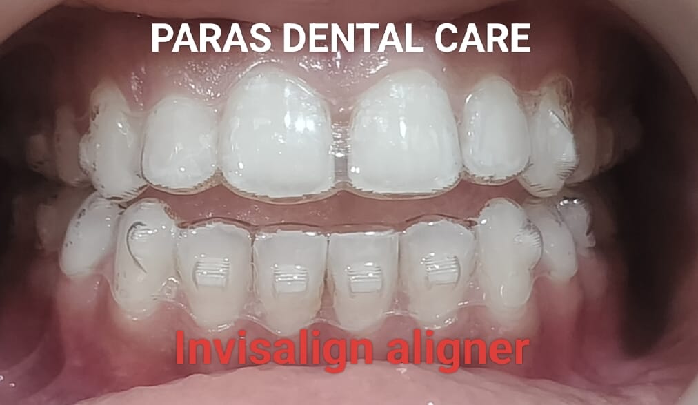 Invisalign at Paras Dental Care
https://boost.nowf... main image