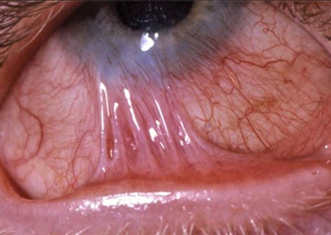 Expert Symblepharon Treatment in Nagpur Underst... main image
