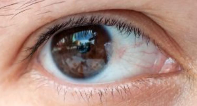 Advanced Pterygium Surgery in Nagpur What is Pt... main image