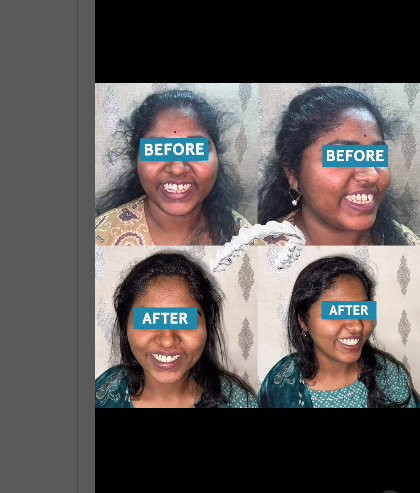💎Gaps in between the teeth corrected with Invis... main image