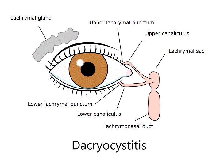 Effective Dacryocystitis Care in Nagpur What Yo... main image