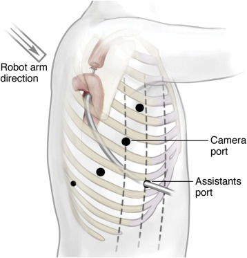 Why ROBOT ASSISTED ESOPHAGEAL SURGERY Robot-assist... main image