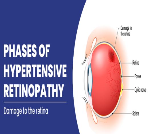 Managing Hypertensive Retinopathy with Expertis... main image