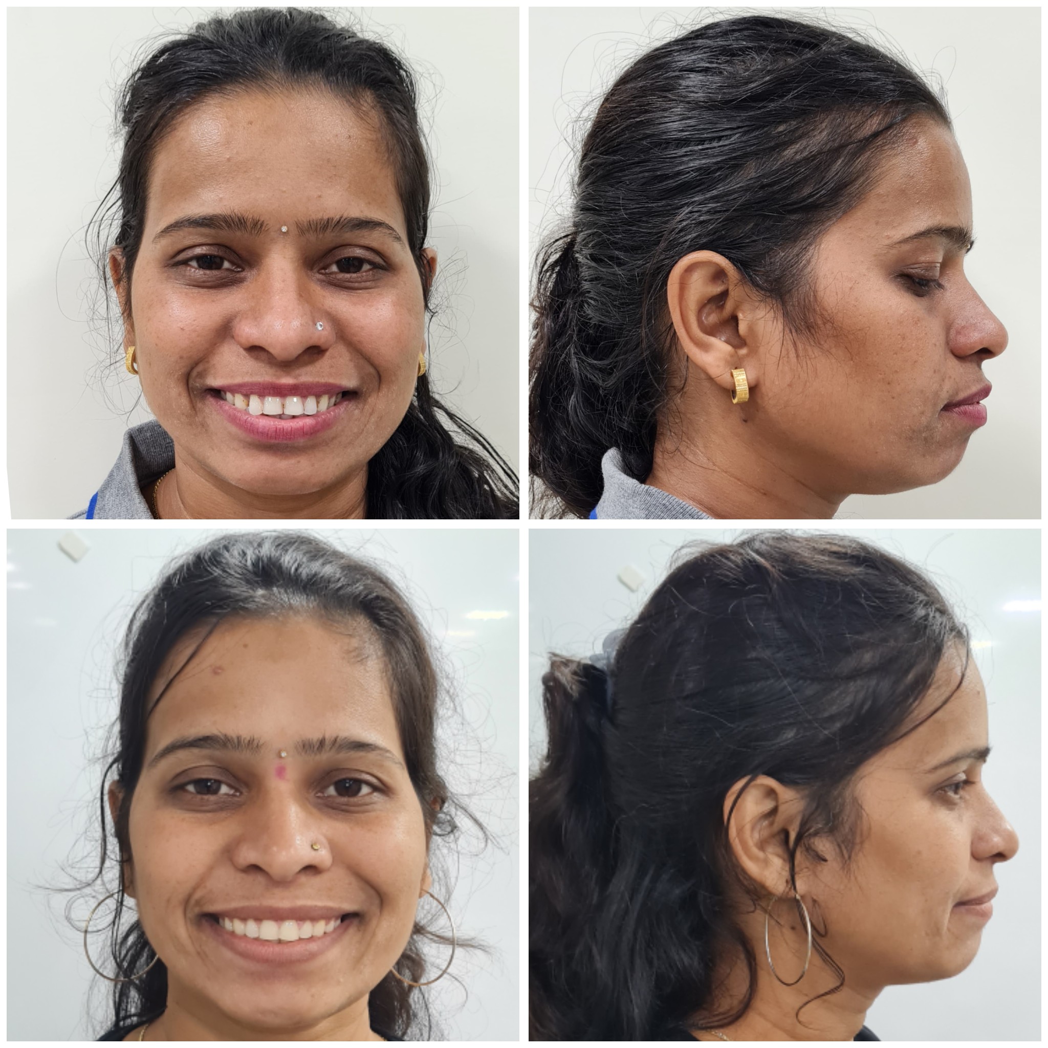 ORTHODONTIC  (BRACES) TREATMENT and SMILE DESIG... main image