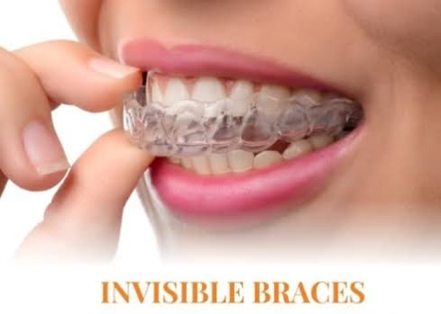 Clear aligners, also known as invisible braces,... main image