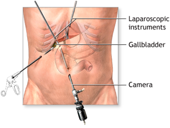 Advanced Gallbladder Lap Surgery by Dr. Bineet ... main image