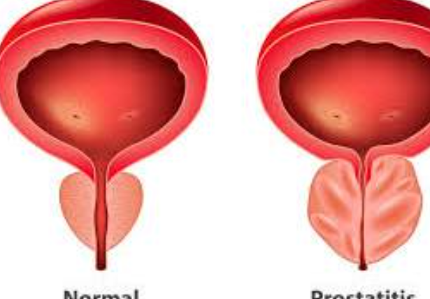 Prostatic Diseases Management at LifeShell Hosp... main image