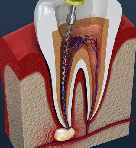 Best Root Canal Specialist in Nagpur Trust the Bes... main image