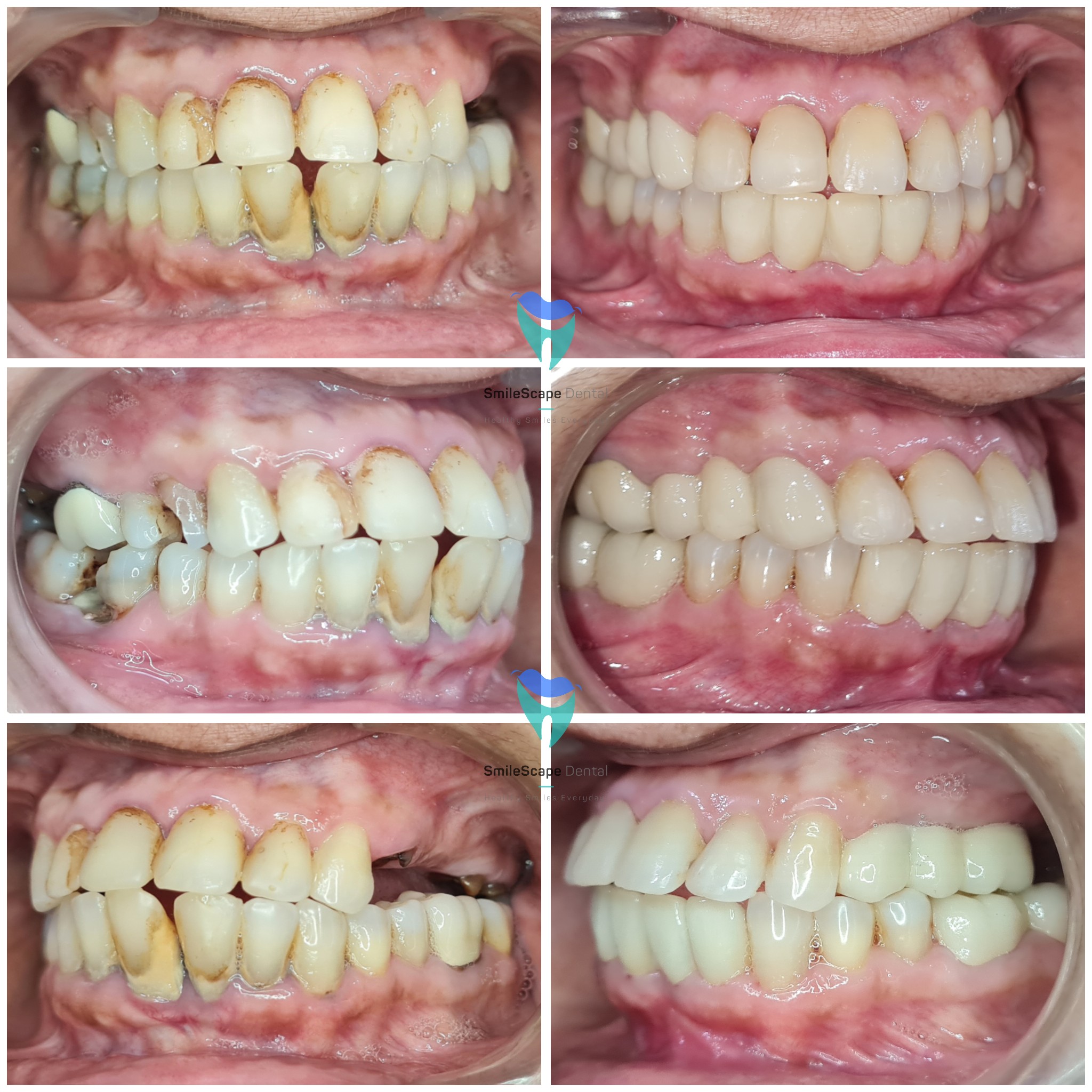 Missing teeth has a negative impact on digestio... main image