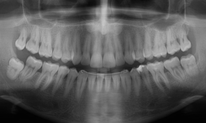 Advanced OPG (Dental