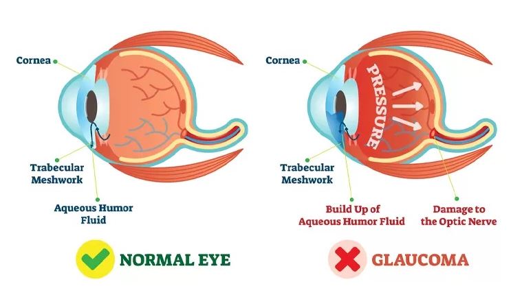 Glaucoma Management at Green City Eye Clinic, N... main image