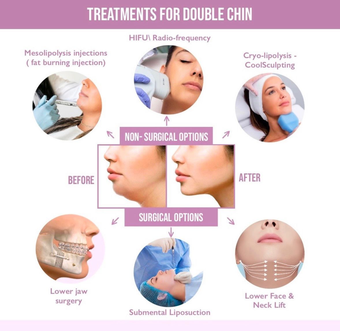 Ultimate Guide to Double Chin Treatments at Finess... main image