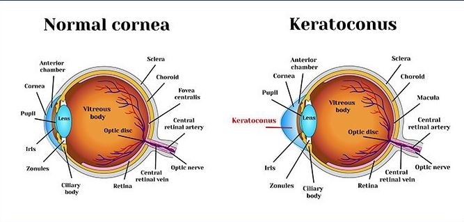 Keratoconus Treatment at Green City Eye Clinic,... main image