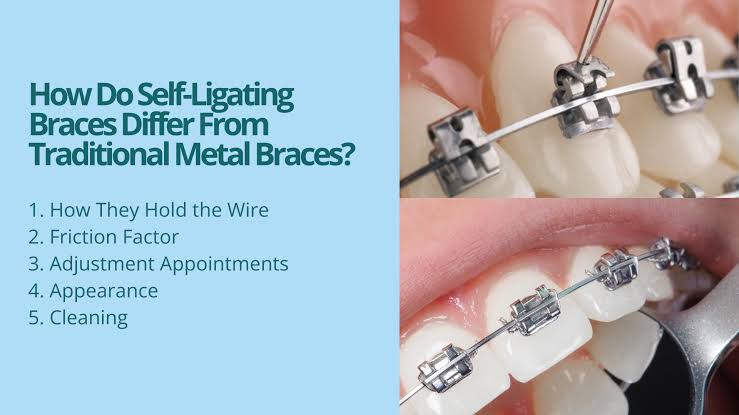 Discover the Benefits of Self-Ligating Braces a... main image