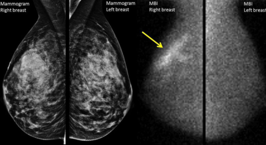 Mammography at Vivek