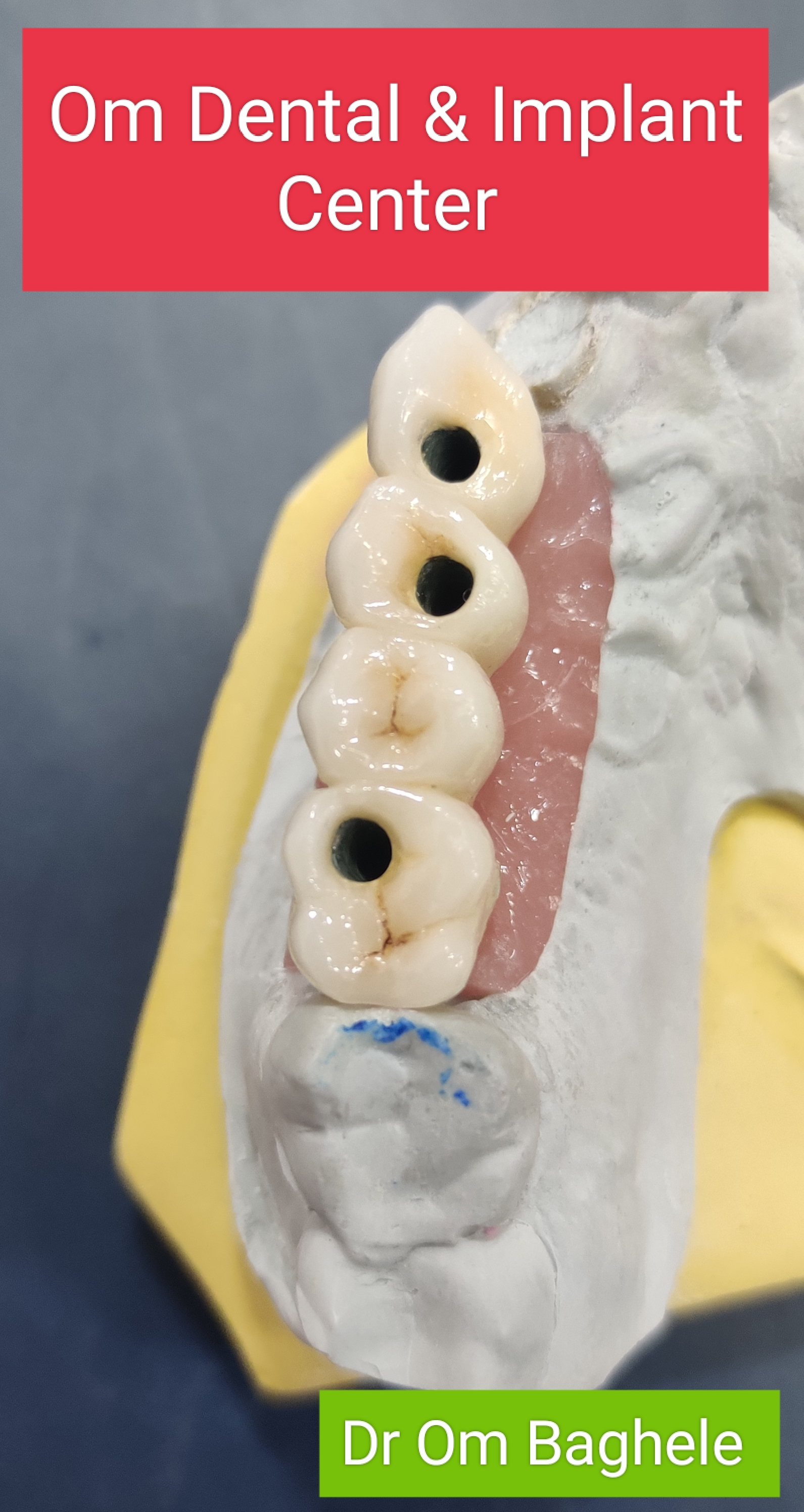 Implant supported screw retained bridge.
#OmDe... main image