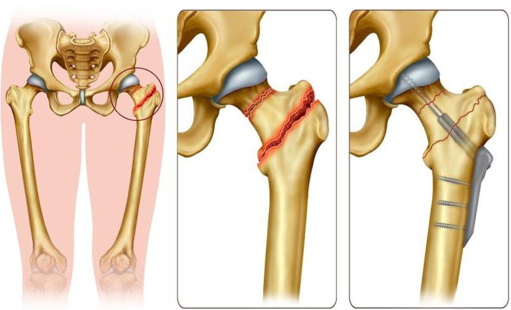 Neck of Femur Fracture Care at KC Hospital Comp... main image