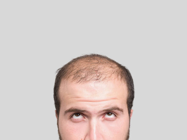 Hair Loss and Balding in R.A. Puram Effective Solu... main image
