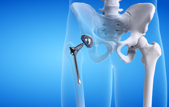 Hip Replacement Surgery at KC Hospital in Avadi Pr... main image