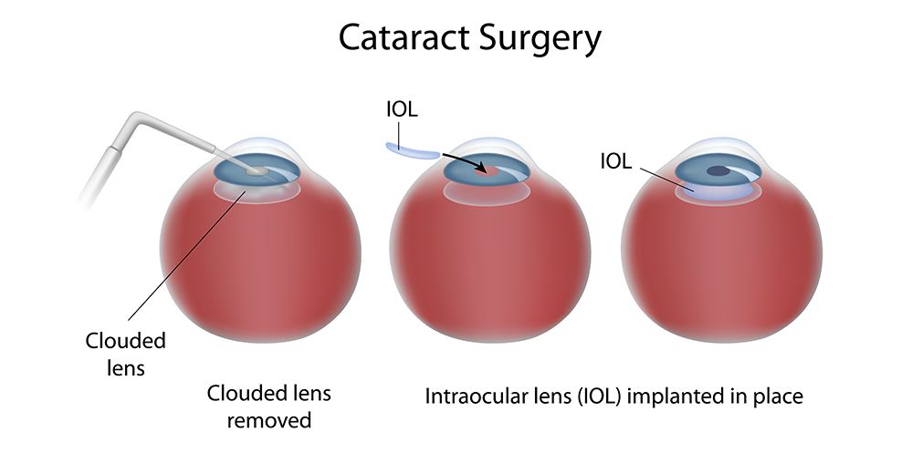 Best Cataract Surgery in Nagpur Restore Your Vi... main image