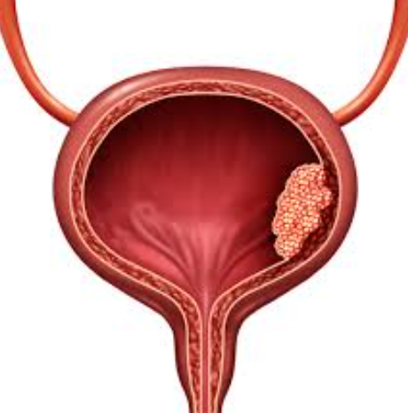 Cancers of the Urinary Tract: Expert Care Speci... main image