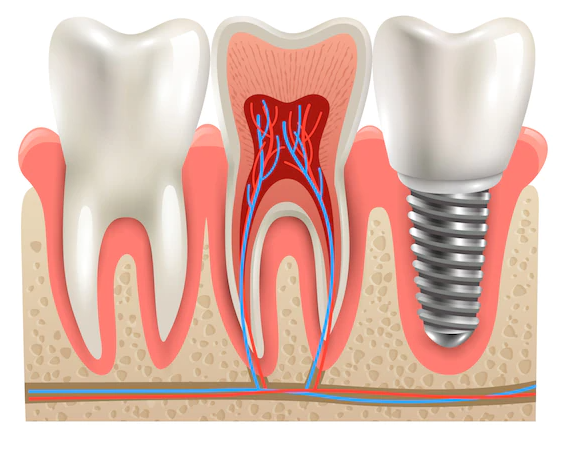 Painless RCT at Dr. Rai's Dental Avenue, Thane Exp... main image