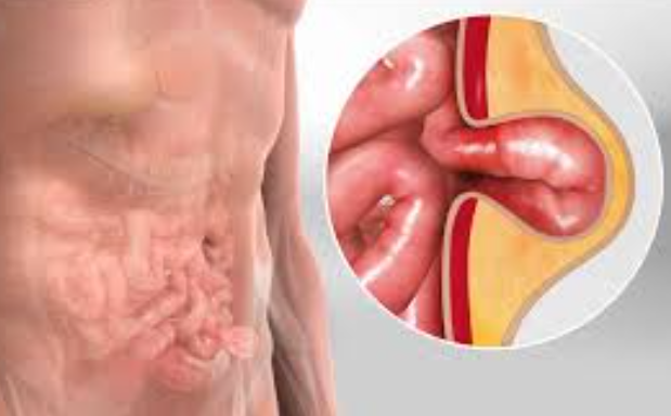 Best Hernia Surgery in Bhayandar Dr. Rajiv Manek –... main image