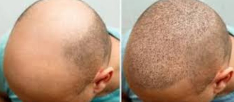 Top Treatments for Hair Fall at Eloraa cliniq C... main image